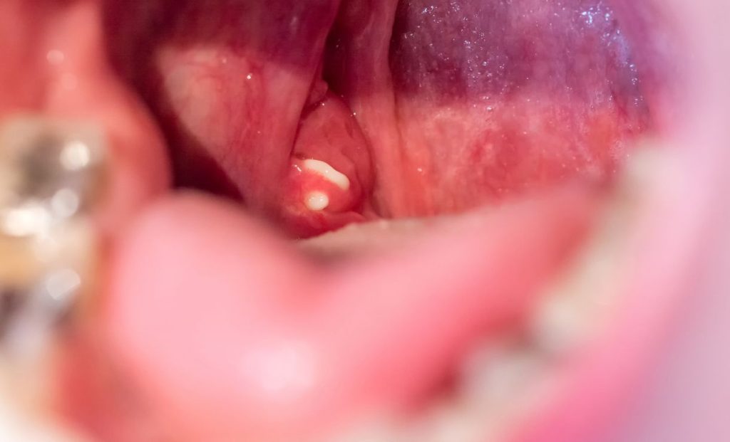 Cáseos Amigdalianos (1)