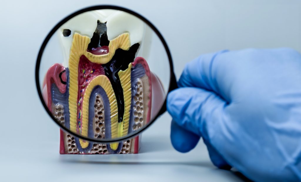 carie na raiz do dente