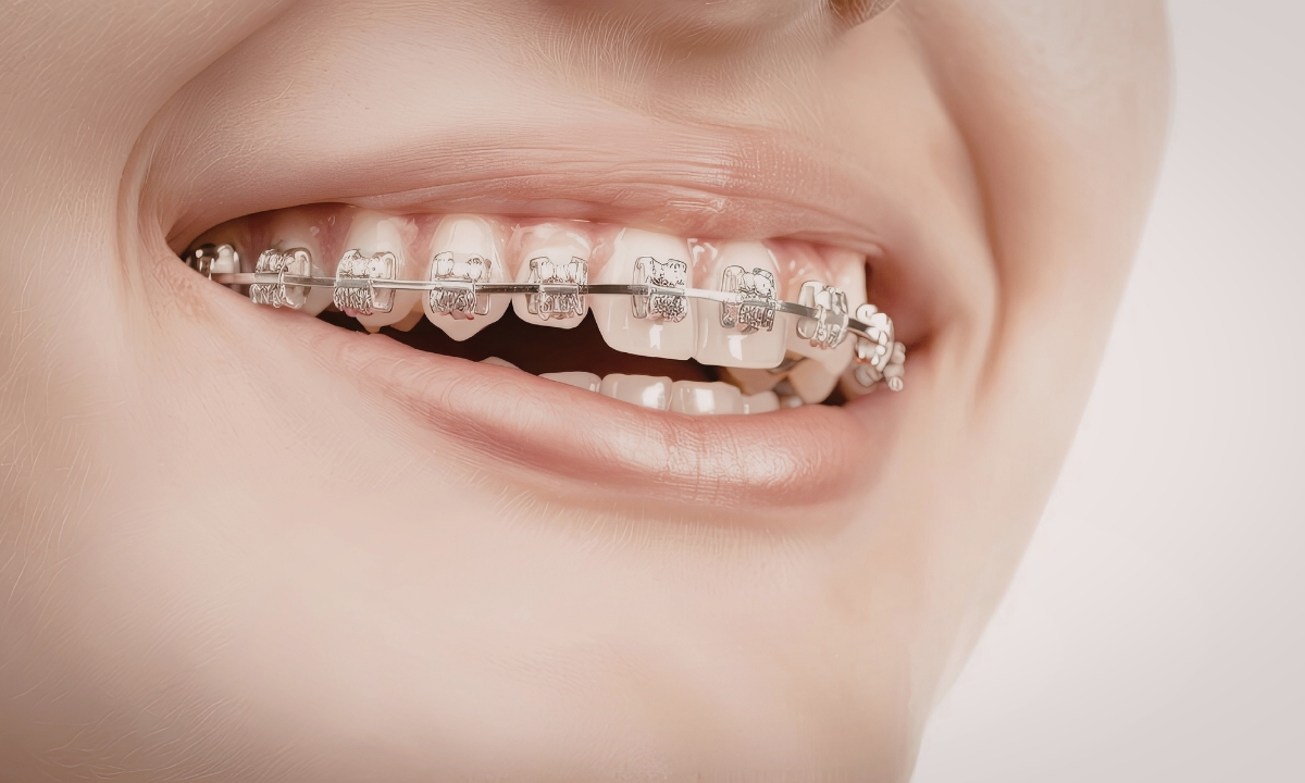 aparelho transparente